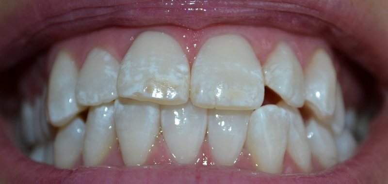 Close-up of the same client's teeth after whitening