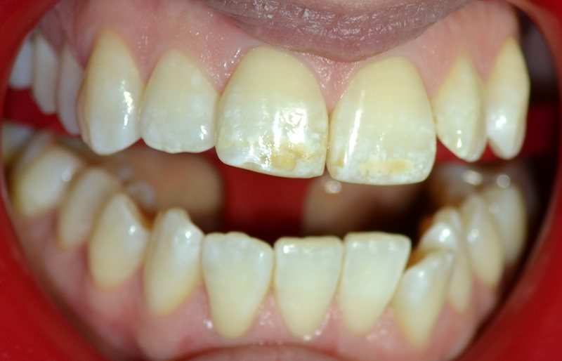 Close-up of a client's teeth before whitening